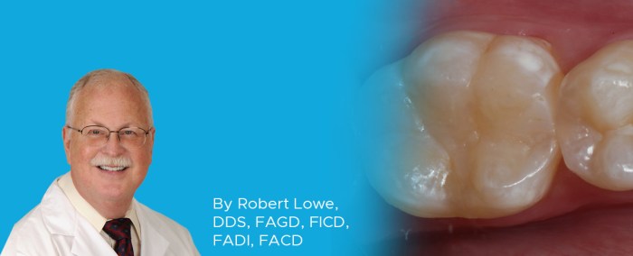 Composite posterior class tooth numbers restorations ii direct study case dentalcompare wedges proximal fender occlusal