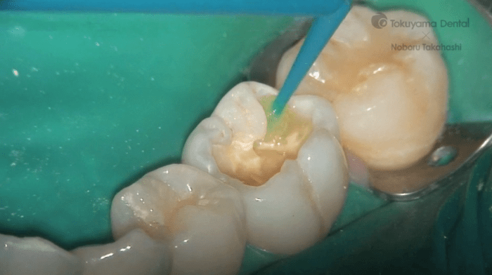 Resin based restoration two surfaces posterior