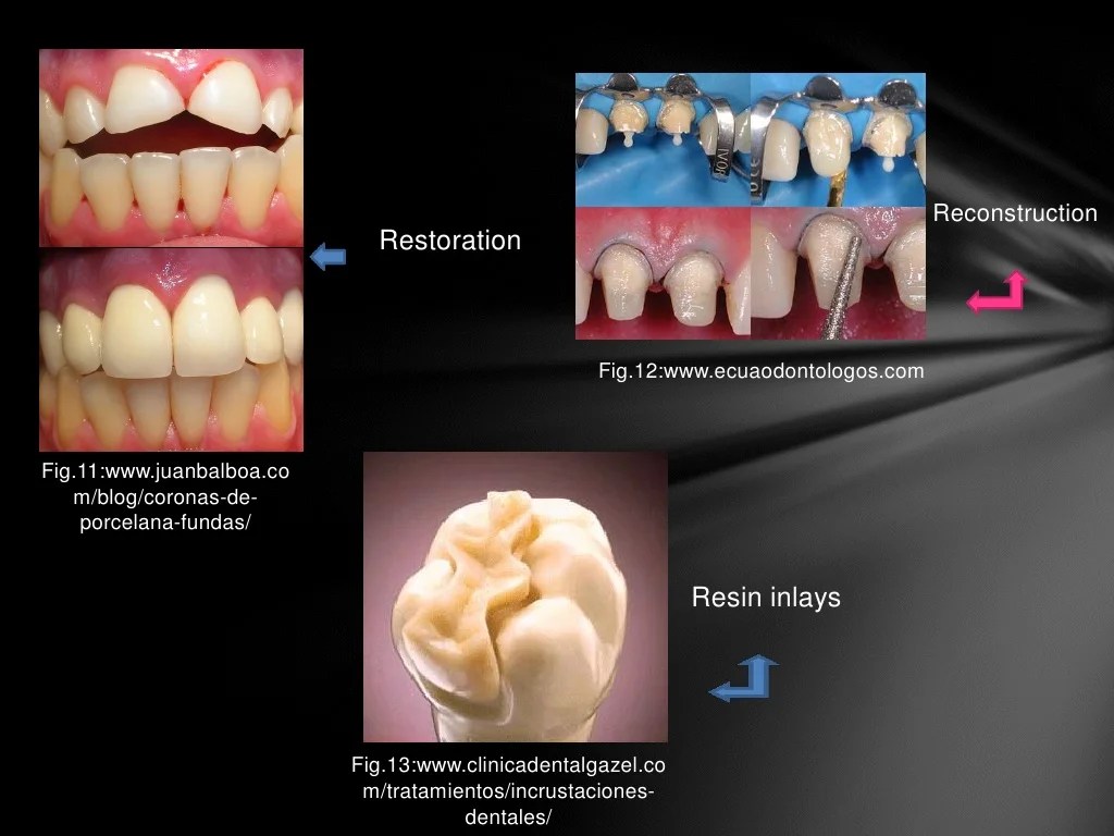 Resin based restoration two surfaces posterior